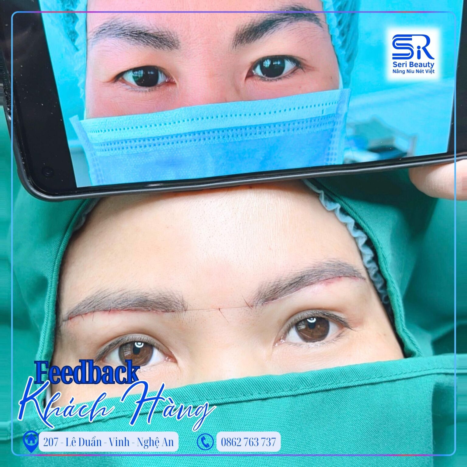 nâng cung mày tại seri beauty