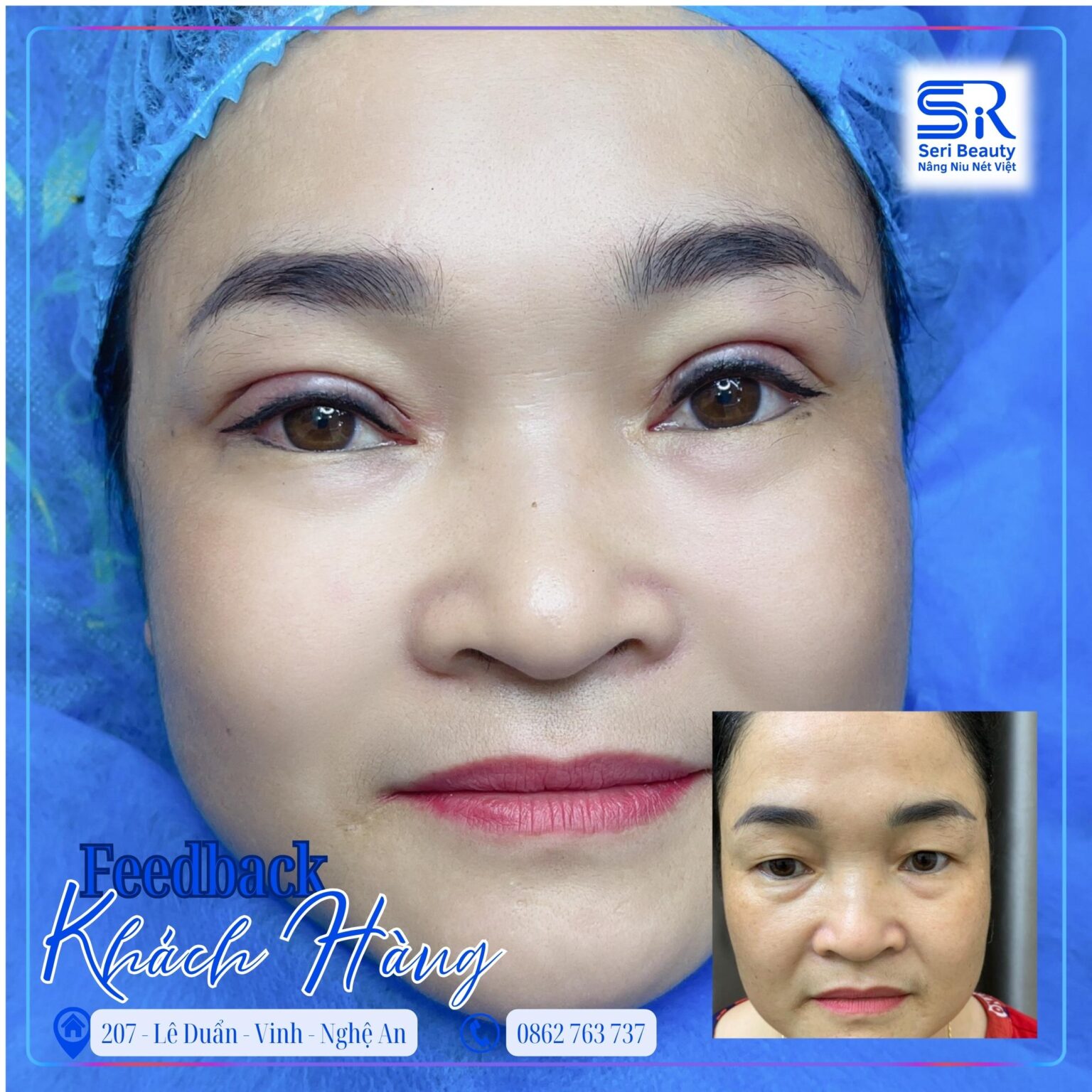 Khách hàng thực tế cắt mí