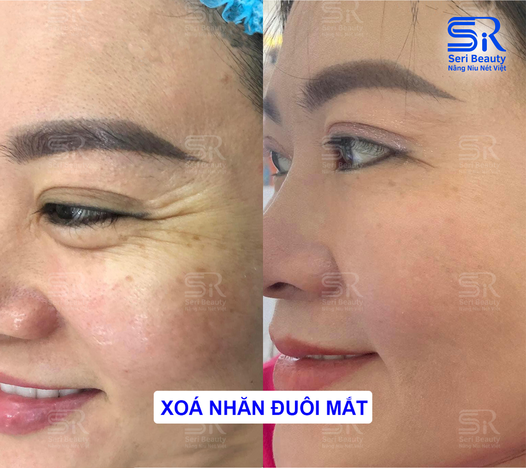 Xoá nhăn đuôi mắt tại Seri Beauty